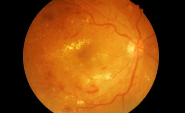 Image of Eye with Diabetic Retinopathy