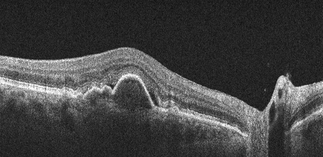OCT image of macular degeneration